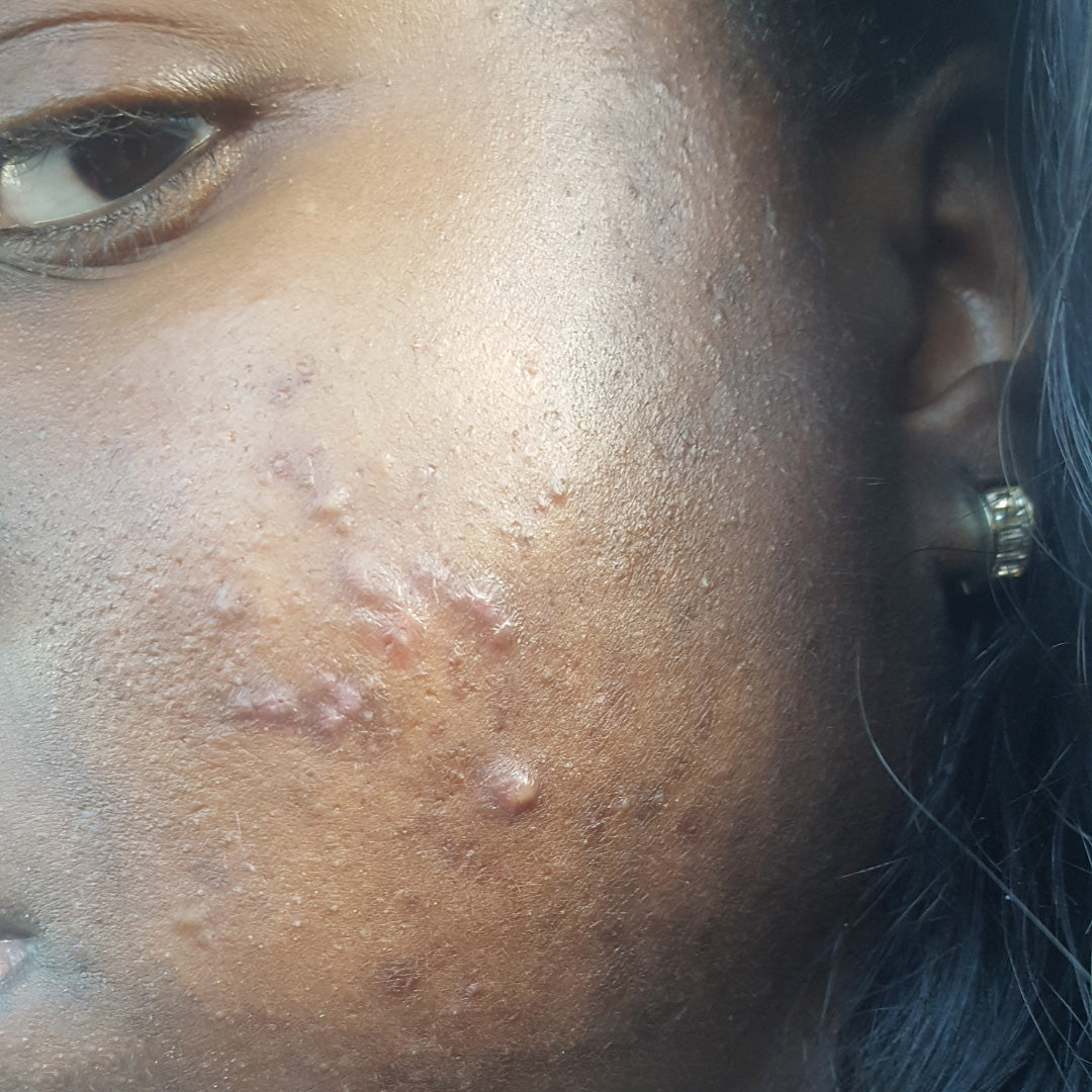 Bumpy Skin/Acne