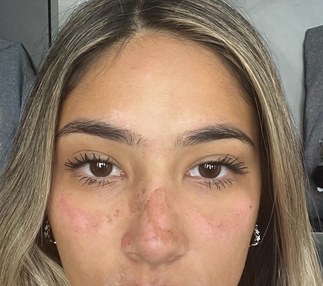 Sun Burn