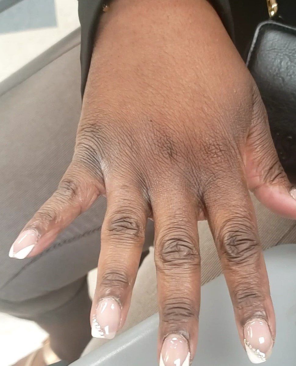 Dry Skin