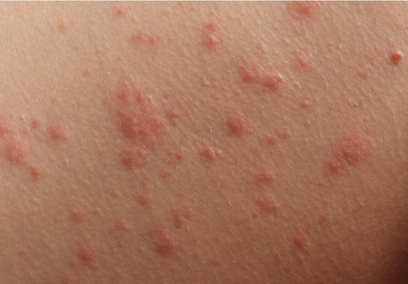 Eczema/ Psoriasis